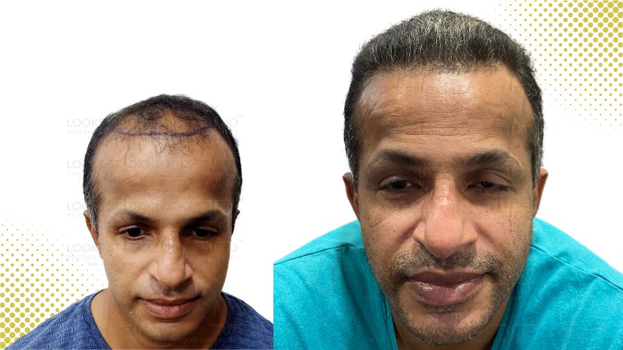 Looks Studio Hair Transplant Results
