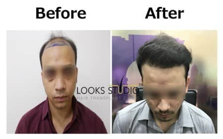 Best Hair Transplant in India | Looks Studio