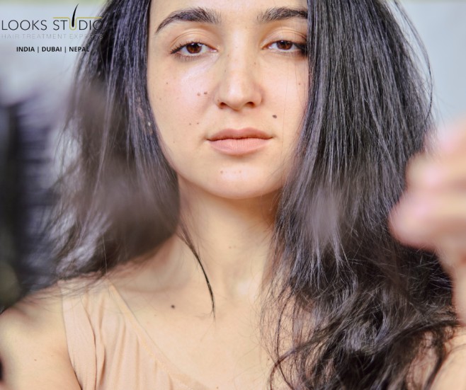 Female Hair-Loss-Baldness