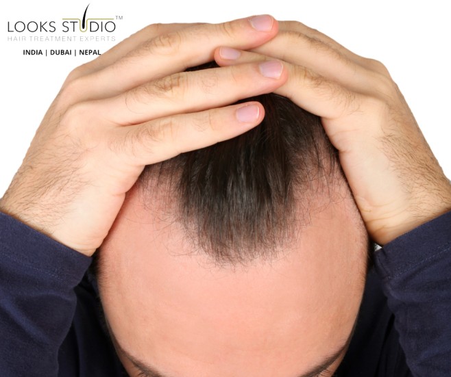 Discover the Different Types of Hairlines