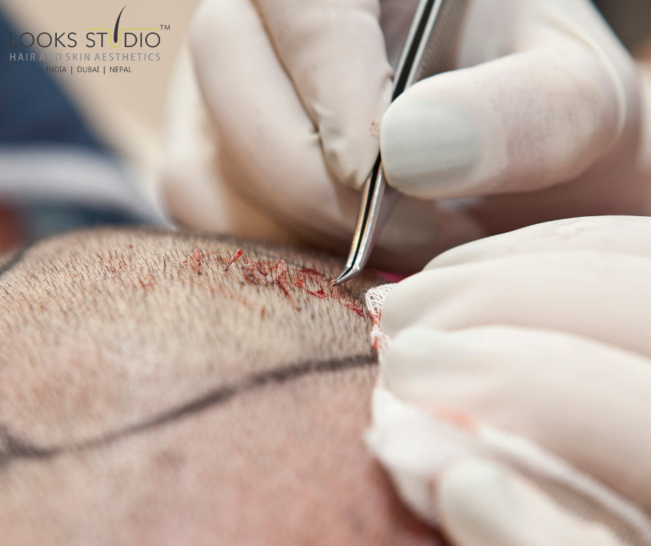 Hair Transplant Pain