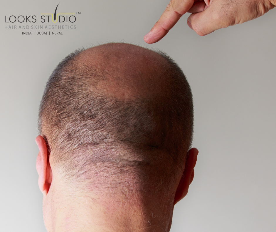 Hair transplant cost