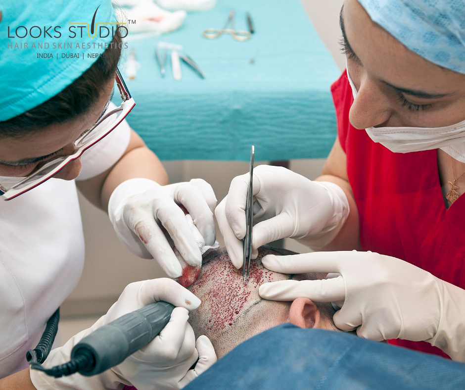 hair transplant lifespan