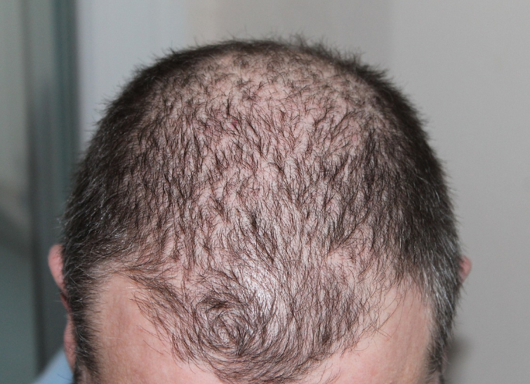 Hair Transplant in Ahmedabad