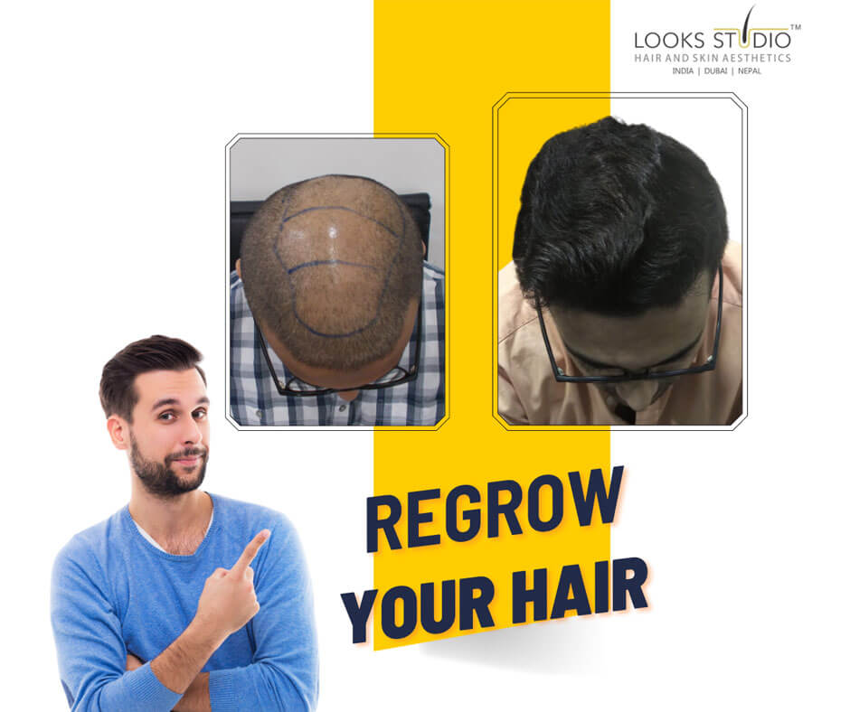 Best Hair Transplant Surgeon in Ahmedabad
