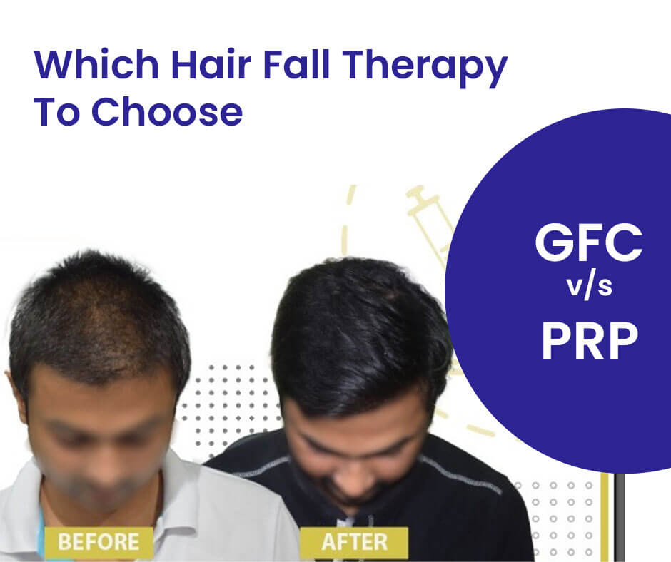 GFC VS PRP - Choosing the Right Therapy for Hair Fall