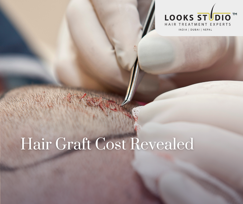 Hair graft cost explained with an image showcasing a confident individual post-hair transplant at Looks Studio