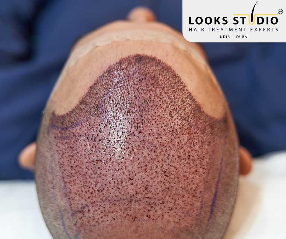 Hair Grafts Cost Planning