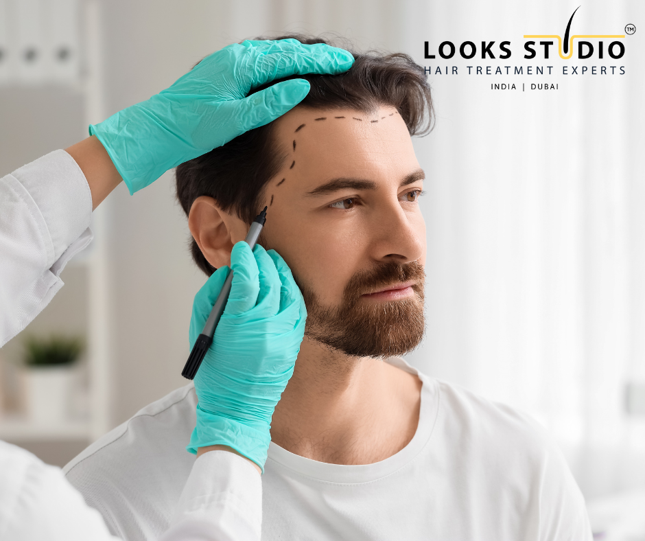 Hair Transplant vs Wig