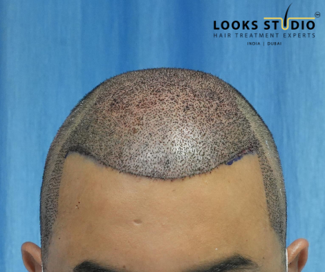 Does Hair Transplant Cause Cancer