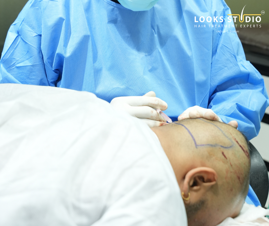 Per graft hair transplant Hyderabad