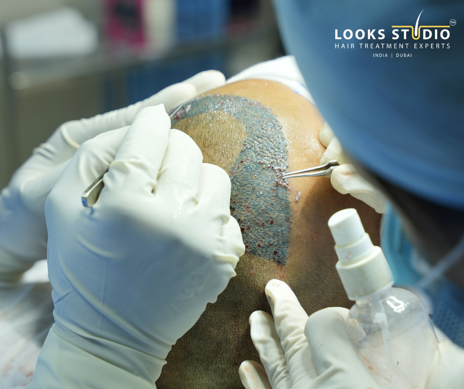 per graft hair transplant Bangalore