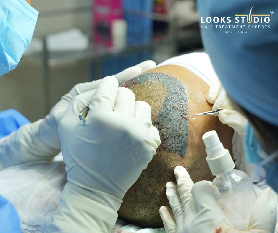 per graft hair transplant Mumbai