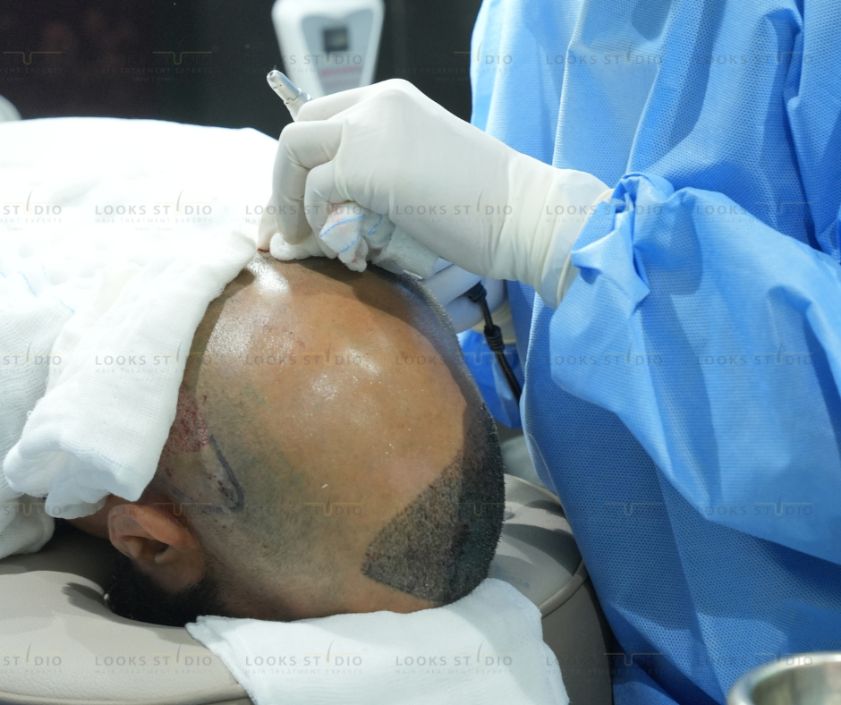 Safe hair transplant clinic