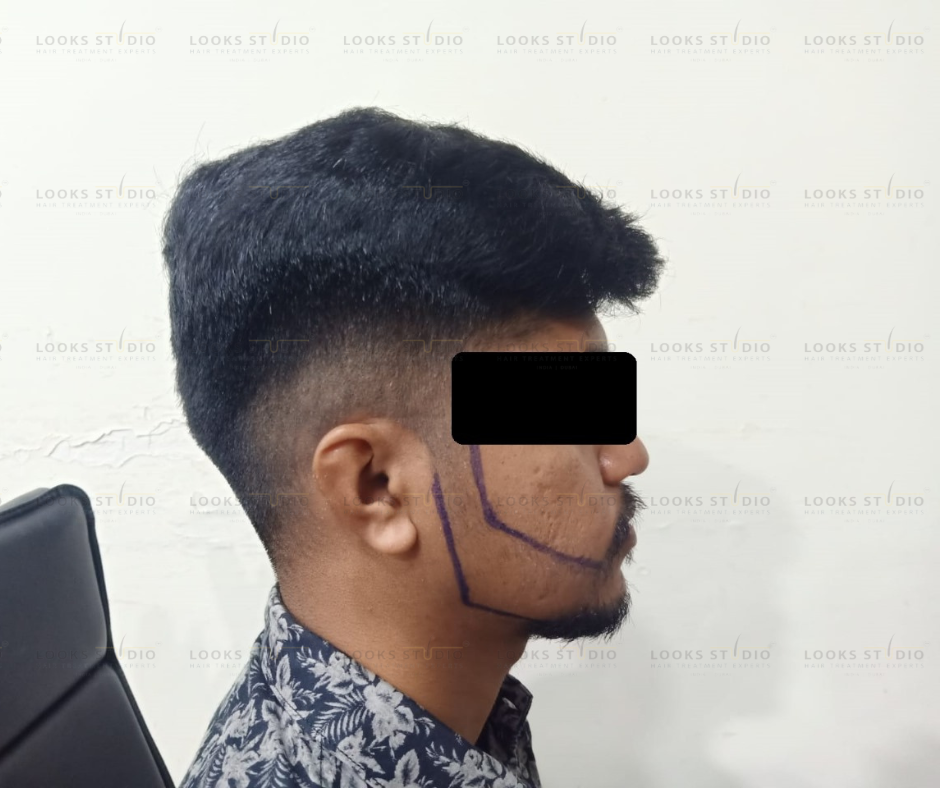Beard Transplant Cost in Mumbai 2026