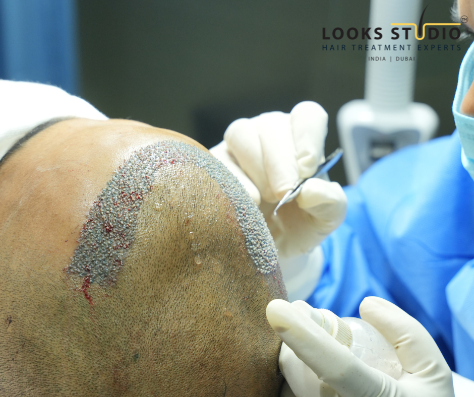 grafts for grade 4 baldness