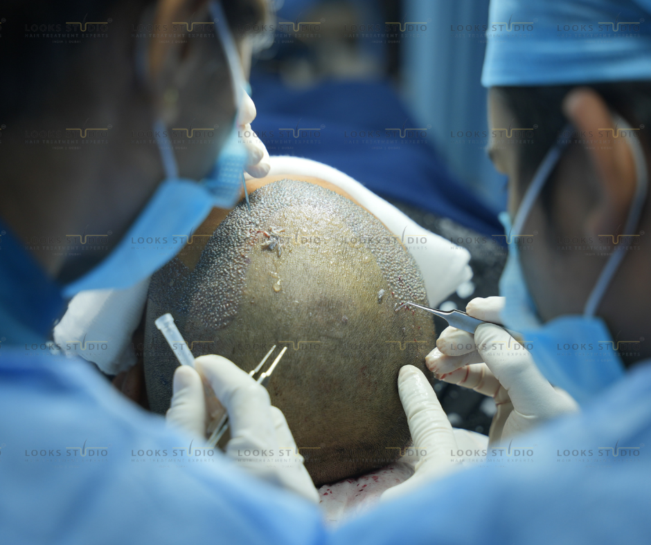 hair transplant cost in india