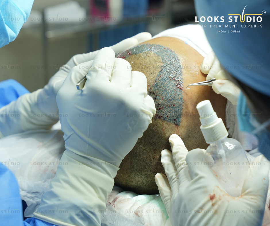hair transplant recovery timeline