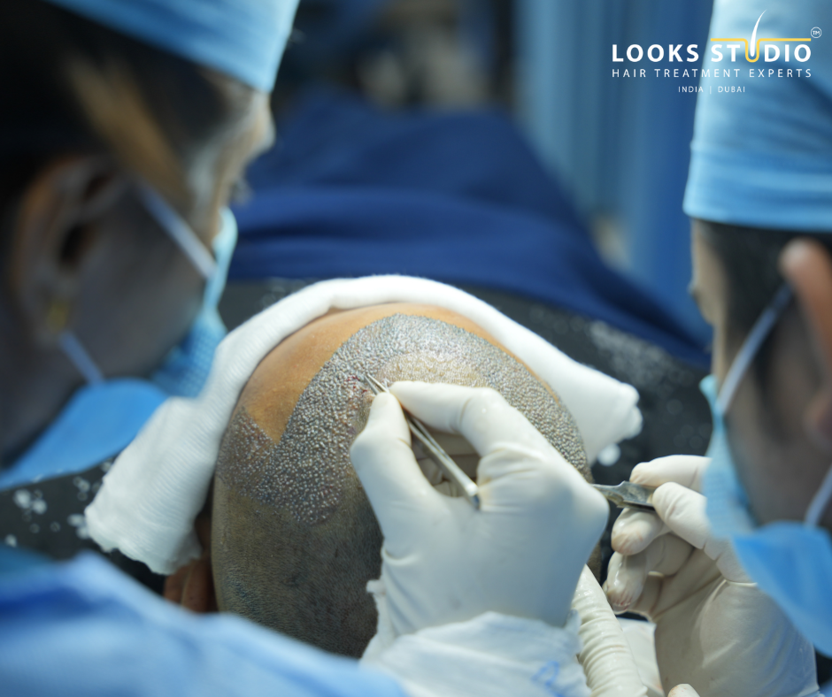 FUE vs FUT vs DHI Hair Transplant