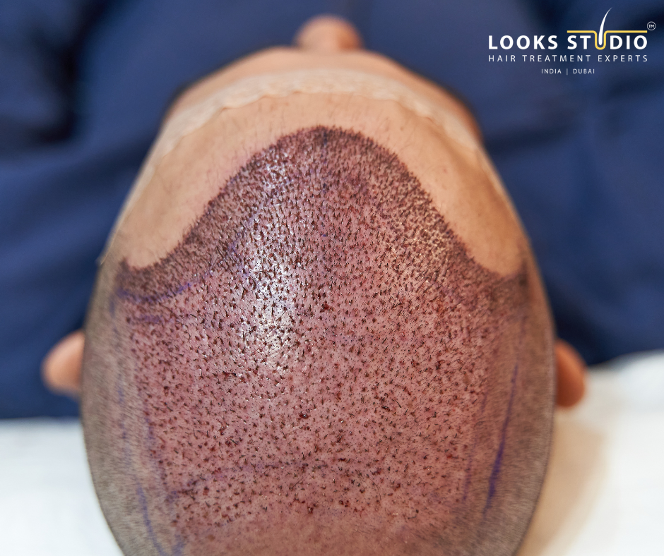 Gym after hair transplant